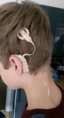 Cochlear Implant Retainer Clip